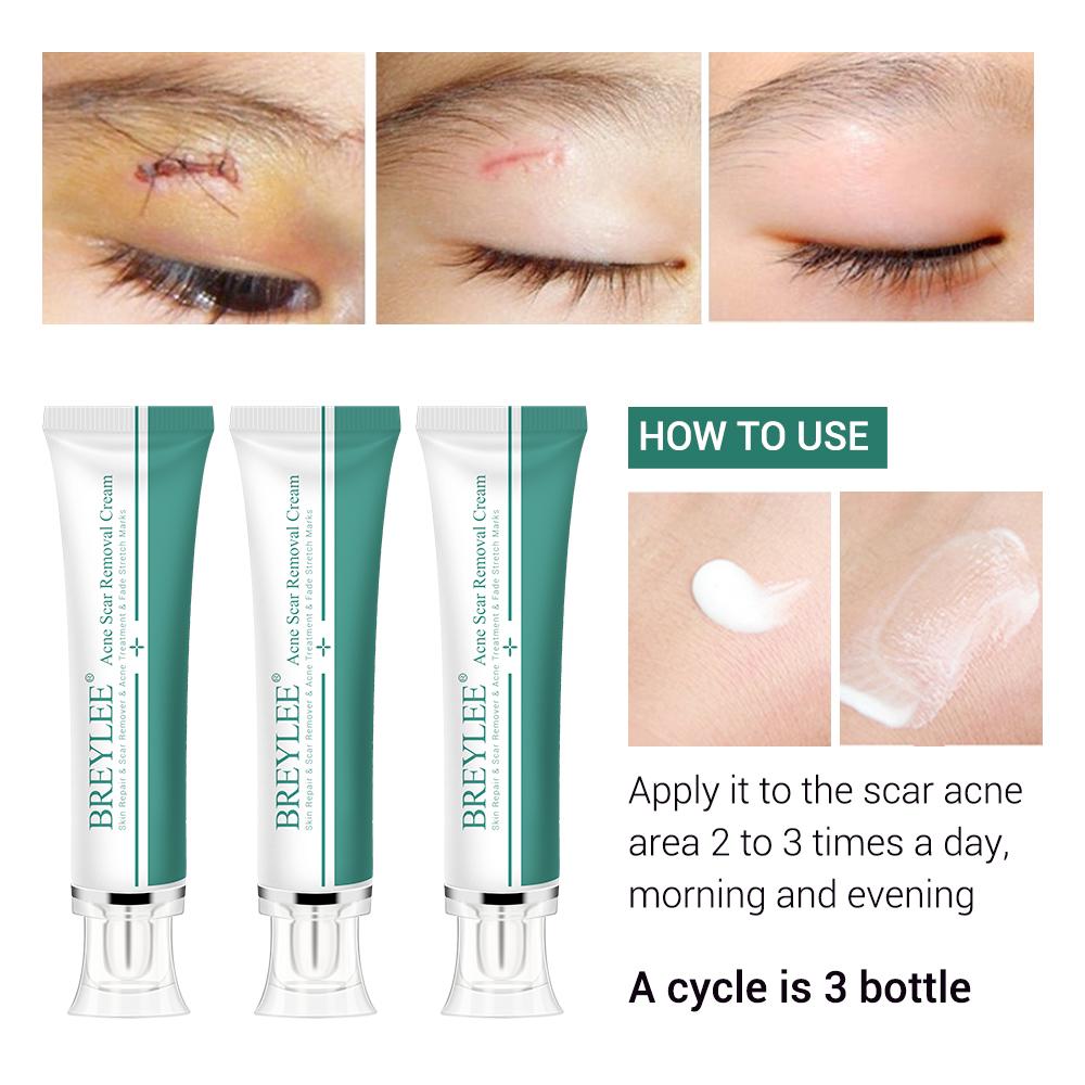 ACNE SCAR REMOVER CREAM