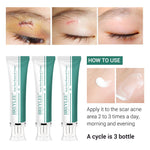 ACNE SCAR REMOVER CREAM